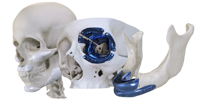 implantes sob medida
