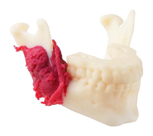 cancer-mandibula-biomodelo-removebg-preview