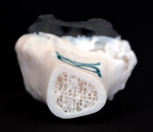 osso-femur-trabecular