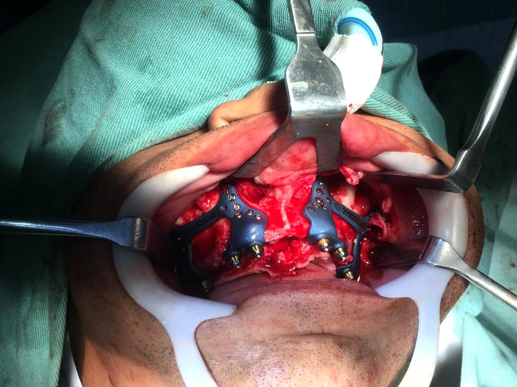 Foto da cirurgia de maxila do Dr. Vinhadelli